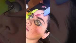 Cosmetic brow tattoo removal at Well Medical arts in Seattle [upl. by Kenwood449]