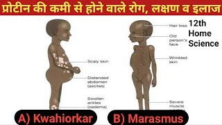 प्रोटीन की कमी से होने वाले रोग लक्षण व इलाज  Kwashiorkor disease  Marasmus disease [upl. by Jdavie997]