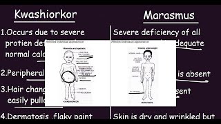 Kwashiorkor vs Marasmus Quick Differences amp Comparison [upl. by Marlena]