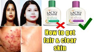 Lacto Calamine lotion reviewusesbenefitshow to get clear and fair skin [upl. by Dviad810]