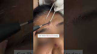 Warts Treatment  Warts Removal Procedure dermatologist skincare wartstreatment skinspecialist [upl. by Okimuy762]