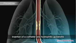 SampG BiotechEGIS Esophageal Stent [upl. by Enomad]