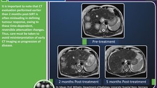 Post Treatment Imaging for SIRSpheres Y90 resin microspheres [upl. by Audwen]