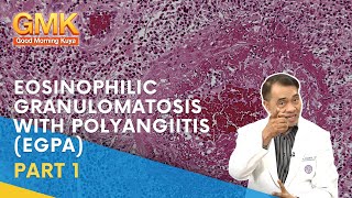 Eosinophilic Granulomatosis with Polyangiitis EGPA Part 1  Usapang Pangkalusugan [upl. by Nisen]