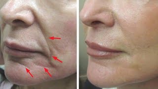 Just 2 skin tightening and face lifting home remedies [upl. by Serle935]