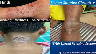 Lichen Simplex Chronicus  Treatment of thickened itchy skindry eczema treatment Dr Uttam Lenka [upl. by Aihsoj]