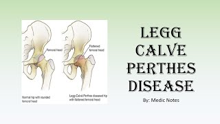 Perthes disease  clinical features investigation Waldenstrom staging Herring classification [upl. by Coats]