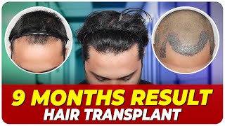 Hair Transplant Time Lapse  Step by Step Hair Transplant Surgery Time Lapse [upl. by Ardiedak371]