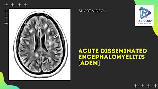 Acute disseminated encephalomyelitis MRI  ADEM Umamaheswara ReddyV [upl. by Assenahs]