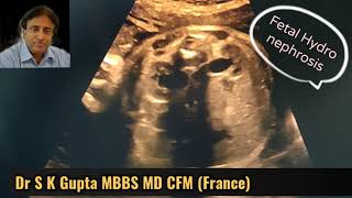 Fetal Hydronephrosis Renal Pyelectasis गर्भ शिशु के गुर्दे मैं सूजन क्यो होती है क्या इलाज [upl. by Prent]