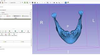 Mandibular osteotomies in orthognathic surgery [upl. by Robb839]