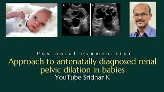 Approach to renal pelvic dilation Antenatal diagnosis of hydronephrosis hydronephrosis ultrasound [upl. by Giorgi449]