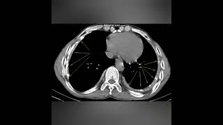 TUBERCULOUS EMPYEMACHRONIC  XRAY AND CT IMAGEA new case every daySame time tomorrow [upl. by Kcir]