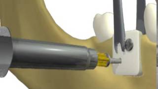 ACE truFIX Bone and Membrane Fixation System  Introduction [upl. by Ahtiuqal]