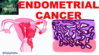 ENDOMETRIAL CARCINOMA Risk factors Etiopathogenesis Morphology amp Clinical features [upl. by Imailiv]