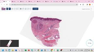 Kaposi sarcoma kaposiform hemangioendothelioma [upl. by Dam]