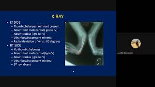 Plastiquest Case DiscussionRadial Club Hand [upl. by Oreste]