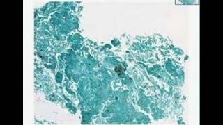 Histopathology Lung Pneumocystis pneumonia [upl. by Isyak123]