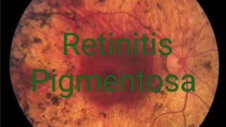 Retinitis pigmentosa RP treatment signs symptoms discussion  Simple version [upl. by Eerol]