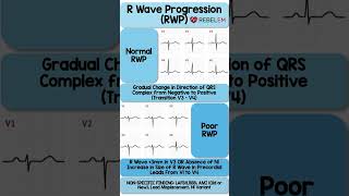 Normal vs Poor R Wave Progression RWP REBELEM ECG EKG RWaveProgression MedEd [upl. by Faustena]