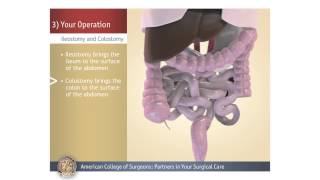 ColostomyIleostomy Your Operation [upl. by Mw]