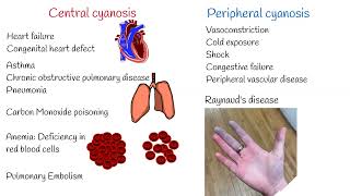 Cyanosis Symptoms and Causes Central and Peripheral Cyanosis [upl. by Longerich]