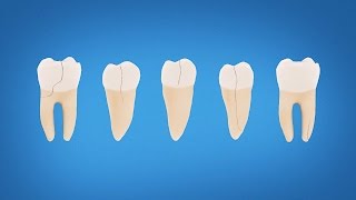 Understanding Cracked Tooth Treatment and Symptoms [upl. by Nilad79]