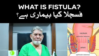 What is Fistula Information for a common man [upl. by Ecidnak]