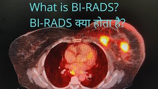 BIRADS क्या होता है What is BIRADS birads breastcancer petct fdg fdgpetscan petctscan [upl. by Aihsat]