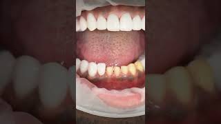 This is how veneers bring life to your teeth dentistry dentist shorts [upl. by Higbee767]