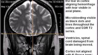 Brain Microbleeding and Hemorrhaging [upl. by Esinahs800]