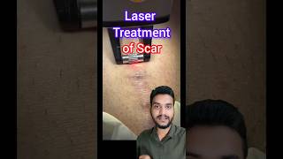 Laser treatment Keloid scar shorts [upl. by Gypsy]