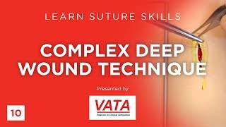 Complex Deep Wound Technique  Learn Suture Skills  VATA [upl. by Clorinde437]