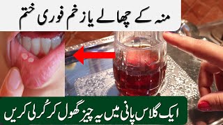 Mun k Chalon ka ilaj amp Mouth Blisters Treatment [upl. by Eido3]