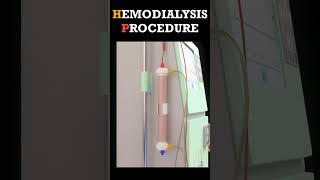 Hemodialysis Procedure shorts dialysis [upl. by Ecnarret]