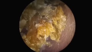 Satisfying Ear Wax Removal With Dokter Tht [upl. by Kassia587]