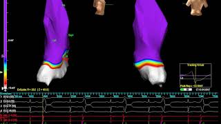 3D construction of a PVC  EP study  ablation l Cardiology Premature ventricular complex [upl. by Enella]