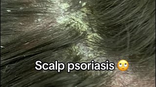 Scalp Psoriasis Removal [upl. by Esiom]