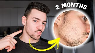 My UNBELIEVABLE Beard Growth in Just 2 Months with Minoxidil and Derma Rolling [upl. by Aimit924]