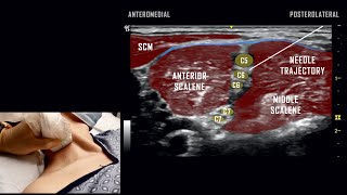 Interscalene Block  Ultrasound Anatomy Review [upl. by Aneehsor]