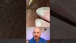 Derm reacts to INSANE ingrown hair extraction dermreacts doctorreacts ingrownhair [upl. by Longerich]