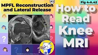 Fig 4A42 MPFL Reconstruction and Lateral Release [upl. by Adnawaj24]