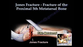 Jones Fracture  Everything You Need To Know  Dr Nabil Ebraheim [upl. by Linder815]