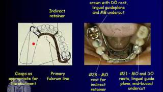 DENT 718 Removable partial dentures design considerations [upl. by Anined541]