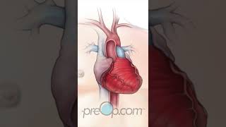 PreOp® 🚨 Understanding Heart Stent Implantation preop shorts health 💖 [upl. by Annohs]