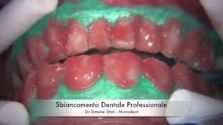 Sbiancamento Professionale dei Denti Teeth Whitening [upl. by Kensell]