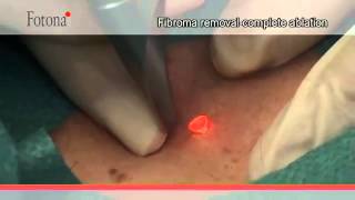 Mole Removal with Fotona Laser  rtwskin [upl. by Idac340]