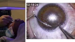 London Vision Clinic  ReLEx SMILE  Live laser eye surgery  Professor Dan Reinstein [upl. by Ahtimat]