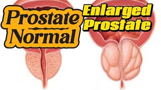 Prostate Enlargement  VUJ stone  UVJ Stone  Urinary Retention  Diverticulum on Ultrasound [upl. by Otreblide]