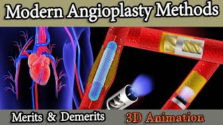 Different Angioplasty Methods Stents Balloon atherectomy Rotablator [upl. by Pride]